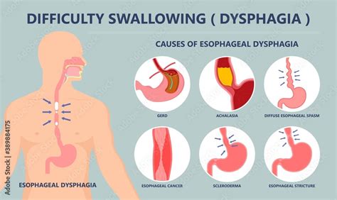Dysphagia Infection Trachea Examine Surgery Choking Gastric Diagnose