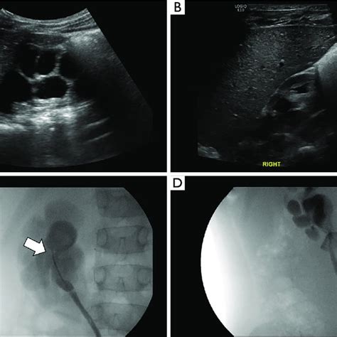 Laparoscopic Pyeloplasty Images A A Crossing Vessel Asterisk With