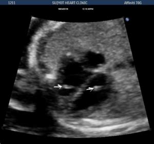 I recently was diagnosed with breast cancer and the pathology report stated two foci of micrometastasis meaning there were a few malignant cells in the node. echogenic-foci-lv-rv - SujyotHeartClinic