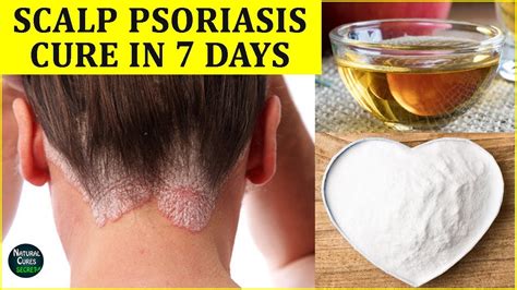 Scalp Psoriasis How To Cure Scalp Psoriasis Naturally In 7 Days Youtube