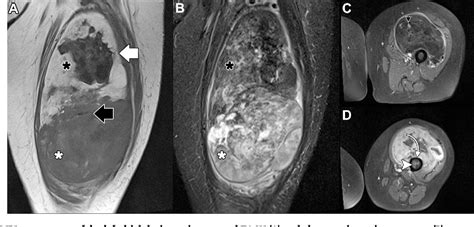 Figure 3 From Liposarcoma Of The Thigh With Mixed Calcification And
