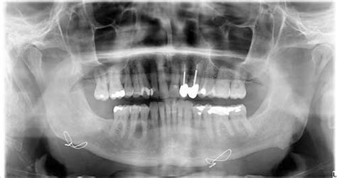 Case Of The Month Diagnosis Uw School Of Dentistry