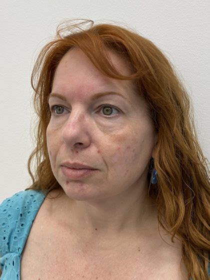Patient Facial Fillers Before And After Photos Alhambra Plastic Surgery Gallery Santa