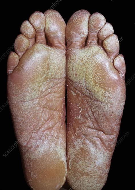 Exfoliative Dermatitis On Soles Of Feet Stock Image C0459557
