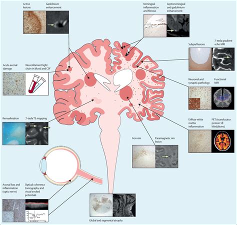 Multiple Sclerosis Progression Time For A New Mechanism Driven