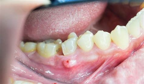 Tooth Abscess Symptoms