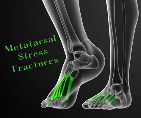 Metatarsal Stress Fractures Canberra Physiotherapy Clinic Tm Physio