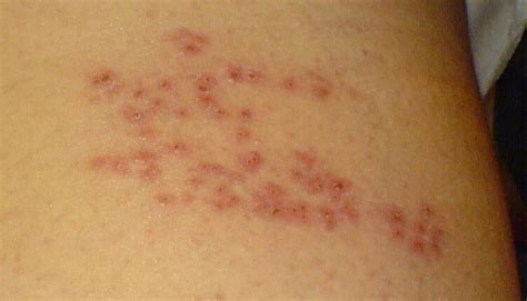 If you put shadows in all the skin color, it will look like the above. Shingles Symptoms and What You Need to Know