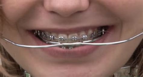braces girlswithbraces metalbraces headgear brackets dentales botella de agua infundida