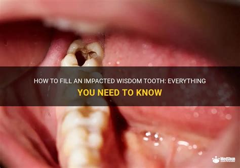 How To Fill An Impacted Wisdom Tooth Everything You Need To Know Medshun