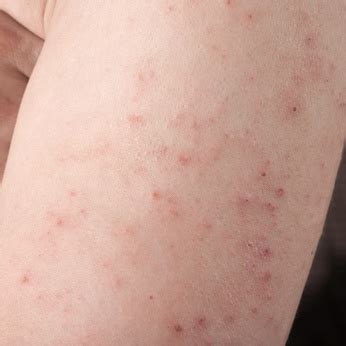 Rashes That Come And Go Possible Causes And Corresponding Treatments