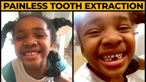 Learn how to pull a tooth safely at home with this tutorial. How To Pull A Loose Tooth | Teeth Pulling Method - YouTube