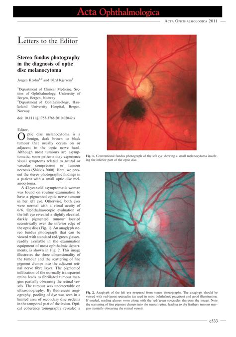 Pdf Stereo Fundus Photography In The Diagnosis Of Optic Disc Melanocytoma