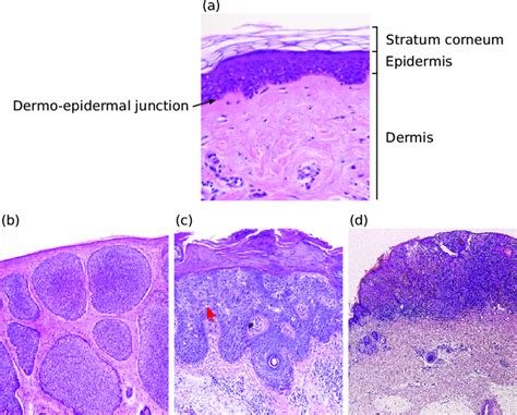 Squamous cell carcinoma (scc) of the prostate is a rare malignant epithelial neoplasm arising in the prostate, with squamous differentiation of the neoplastic cells. Histology slice of (a) a normal skin and histopathology ...