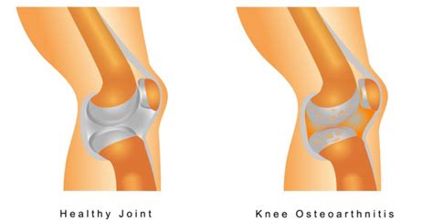 Partial Vs Total Knee Replacement Surgery Doc Blog