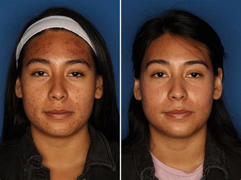 Patient 24560911 Acne Treatment Before And After Photos Laser Cliniqúe
