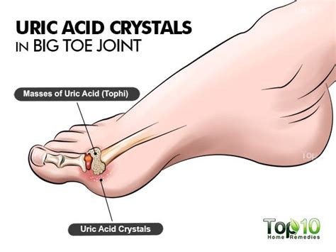 Purines are normally produced in the body and are also found in some foods and drinks. How to Control Uric Acid Levels | Top 10 Home Remedies
