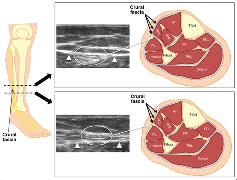 Sonographic Evaluation Of Superficial Peroneal Nerve Abnormalities Ajr