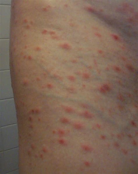 Pityriasis Lichenoides Alchetron The Free Social Encyclopedia