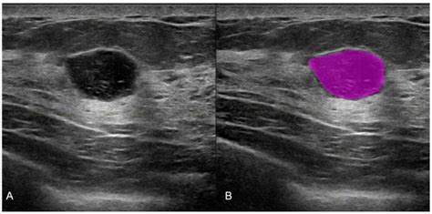 Breast Cancer Malignant Ultrasound Images