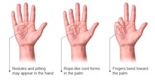 Dupuytren Contracture Causes Symptoms Treatment And Exercises