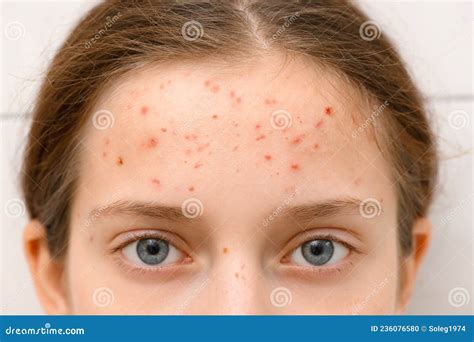 Face Of A Teenage Girl With Pimples Acne On The Skin Portrait Of