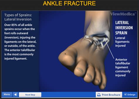 Ankle Fracture Information And Treatments