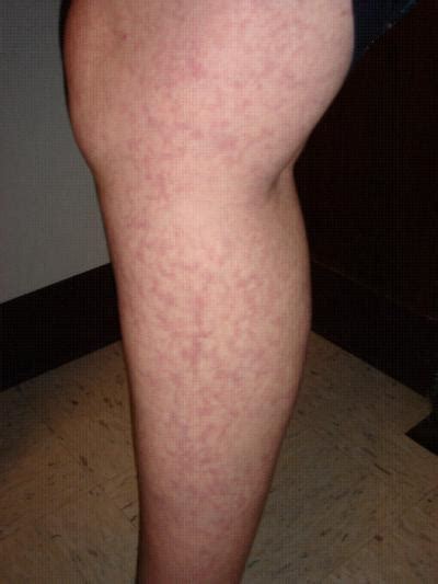 Leg With Livedo Reticularis Image Eurekalert Science News Releases