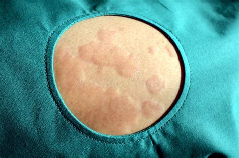 Prurido De Pele Urticaria Reação Alérgica Da Pele Imagem De Stock