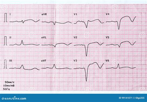 Ecg Con Período Agudo De Infarto Del Miocardio Anterior Extenso Grande