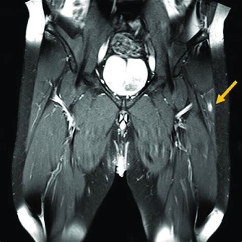 T1 Weighted Fat Suppressed Magnetic Resonance Imaging Mri With