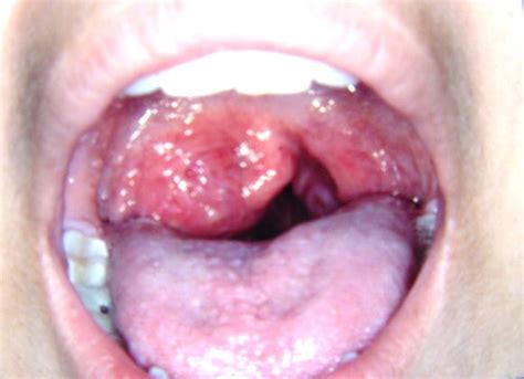 Tonsillar Neoplasms Cancer Of Tonsil Tonsillar Cancer