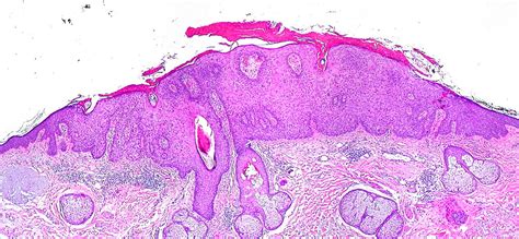Actinic Keratosis Elliptical Excision From The Forehead Of Flickr