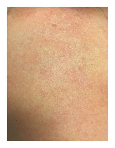 Maculopapular Rash Noted On Admission On The Patients Chest