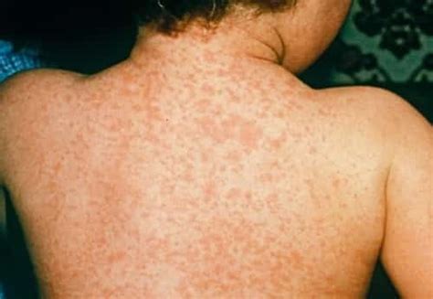 Meningitis Rashes How To Recognize The Disease With Pictures