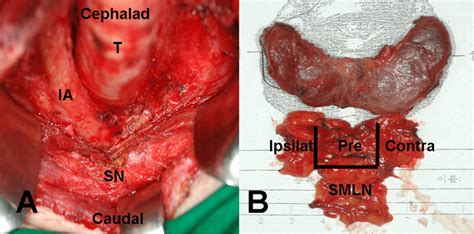Surgical Field And Specimen A Total Thyroidectomy With Central Lymph