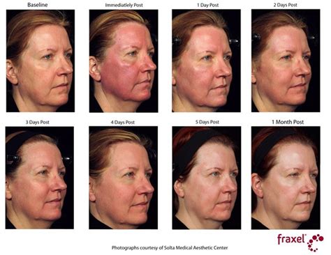 Fraxel New York Laser Skin Resurfacing