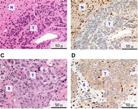 Immunohistochemistry, a procedure used to differentiate between malignant mesothelioma and other cancers, may also be used for determine a positive diagnosis. H&E and immunohistochemical staining of meningioma and ...