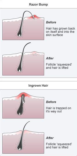 Laser hair removal devices are now. Ingrown hair - (pseudofolloculitis barbae) are bumps ...