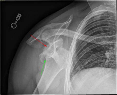 Bilateral Shoulder Dislocation X Rays Case Studies Ctisus Ct Scanning