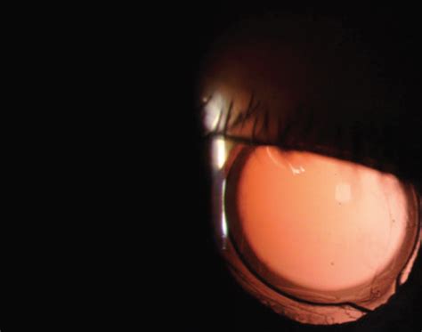 Seeing Halos Around Lights In One Eye After Cataract Surgery