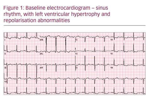 Intermittent Left Bundle Branch Block A Challenging Case Of Rare