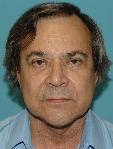 Fast facts on fournier's gangrene: Before & After Photos | Blepharoplasty - Marshall Cosmétique Center - Miami