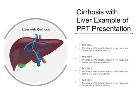 Cirrhosis With Liver Example Of Ppt Presentation Powerpoint Slide