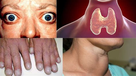 Graves Disease Symptoms Causes Treatment And Role Of Hyperthyroidism