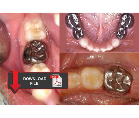 Stainless Steel Crowns Types Procedure And Techniques Odontovida