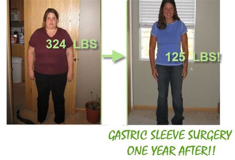 Gastric bypass additionally affects how metabolic rate changes with weight loss. Gastric Sleeve Surgery | Sleeve surgery, Gastric sleeve ...