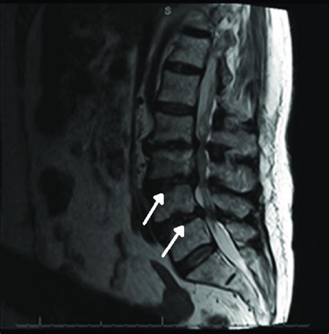 Mri Spine Sagittal View Severe Multi Level Degenerative Disc Disease