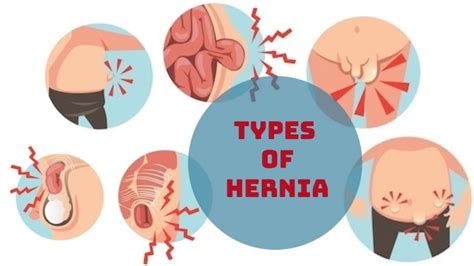 Hernia Types Causes Symptoms Diagnosis Treatment