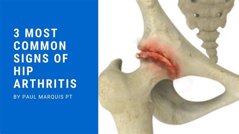 3 Most Common Signs Of Hip Arthritis Youtube